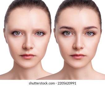 Young woman with bald eyebrows before and after hair transplantation. Alopecia concept. - Shutterstock ID 2205620991