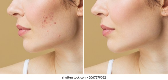 Young Woman Before And After Acne Treatment. Skin Care Concept.