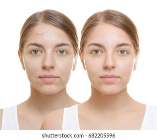 Young woman before and after acne treatment on white background. Skin care concept