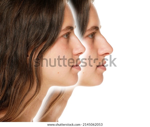 Young woman before and after plastic surgery\
of the nose on a white\
background.