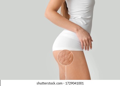 Young woman with cellulite problem on light background - Shutterstock ID 1729041001