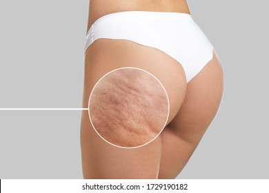 Young Woman With Cellulite Problem On Light Background