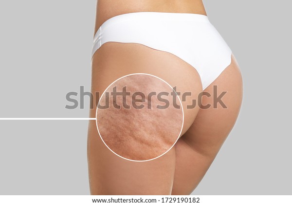 Young\
woman with cellulite problem on light\
background