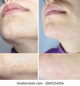 Young Woman With Chin Hairs, Before And After Electrolysis Or Electric Hair Removal