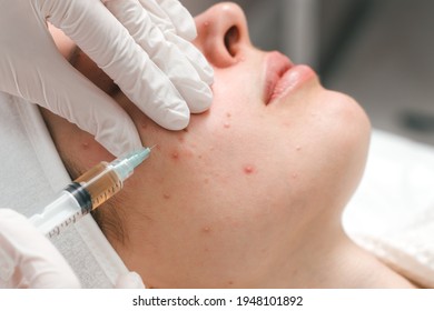 A young woman in a cosmetology clinic, undergoing acne treatment with injections. An effective remedy for acne - Powered by Shutterstock