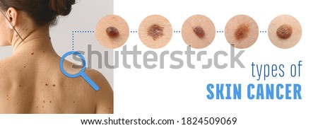 Young woman with different types of moles. Concept of skin cancer