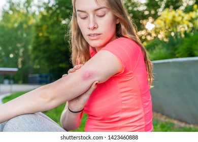 A Young Woman Examines Her Insect Sting On Her Arm