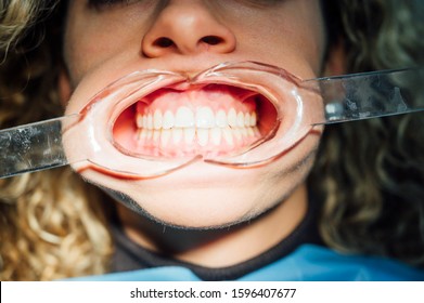 Young Woman Getting Braces Put On Teeth