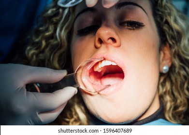 Young Woman Getting Braces Put On Teeth