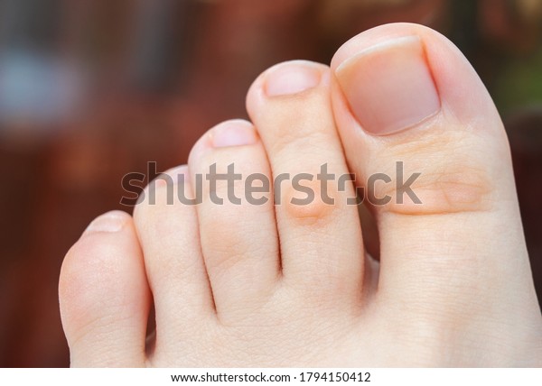 A young woman has hard corns and calluses on her\
toes from wearing shoes that uncomfortable and don’t fit properly.\
Female foot. Close up view.