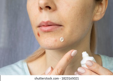 Young Woman Has Skin Problems. A Woman Applies A Healing Cream To Acne On Her Face.