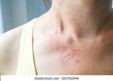 Young Woman Has Skin Rash Itch On Neck