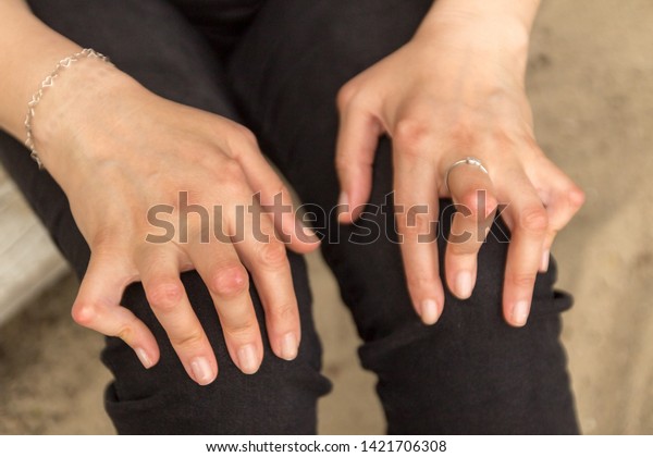 Young Woman Having Rheumatoid Arthritis Takes Stock Photo Edit Now 1421706308