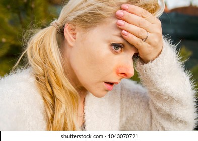 Young Woman With Headache,sniffle And Sinus Pain. Girl Pale Face With Hand On Forehead.Red Nose Skin.