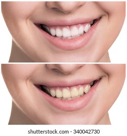 Young woman with healthy smile. Before, after concept