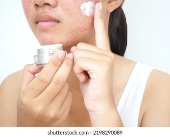 Young woman holding cream jar  and applying acne cream on her face for treat her skin. Concept of beauty and cosmetic. Closeup photo, blurred. - Shutterstock ID 2198290089