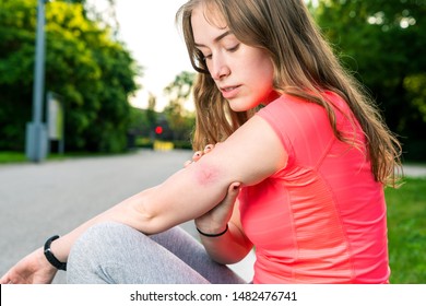 Young Woman With Insect Sting On Her Arm