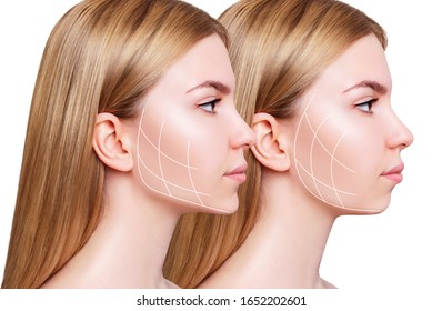 Young woman with lifting lines before and after chin correction. Over white background.