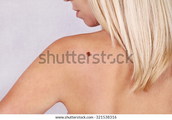 Young Woman Looking Birthmark On Her Stock Photo (Edit Now) 321538316