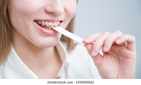 Young Woman With Metal Braces On Her Teeth Is Chewing Gum. The Girl Is Eating Gummy Candy