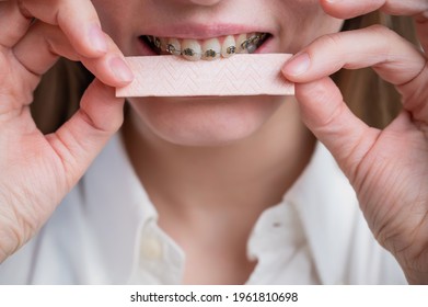 Young Woman With Metal Braces On Her Teeth Is Chewing Gum. The Girl Is Eating Gummy Candy