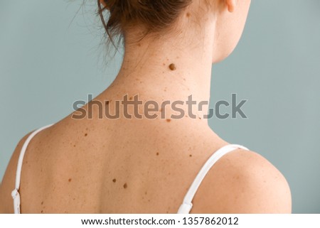 Young woman with moles on grey background