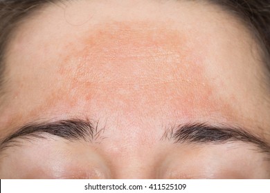 Young woman with pigmented skin - Shutterstock ID 411525109