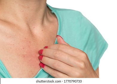 A young woman with pimples on the skin of chest. The girl scratches the skin with an allergic rash on chest.