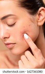 Young Woman Pointing With Finger At Face With Problem Skin Isolated On Beige