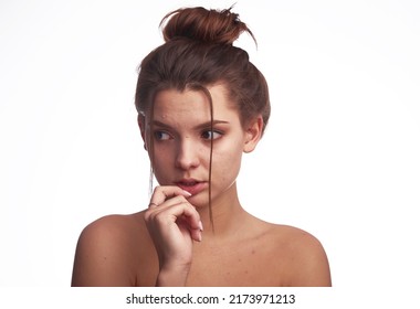 Young Woman Problem Skin. Acne, Pimple, Clear And Clean, Oily, Dry Skin Concept. Cose Up Of Worried Young Lady Touching Her Face Gently On White Background