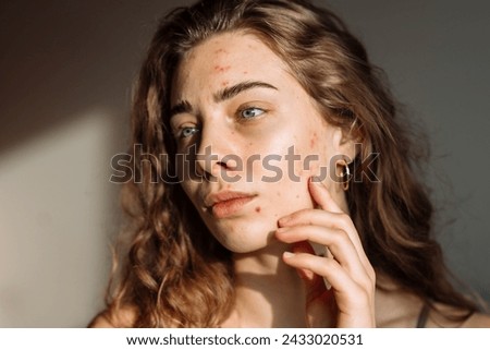 Young Woman with a problem skin. Treatment for acne. Dermatology, cosmetology, skin care.