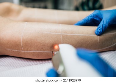 Young Woman Receiving Laser Epilation Or Permanent Body Hair Removal Treatment. Modern Technology And Beauty Concept. Close Up Shot.