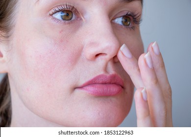 
Young Woman With Rosacea Problem On Face