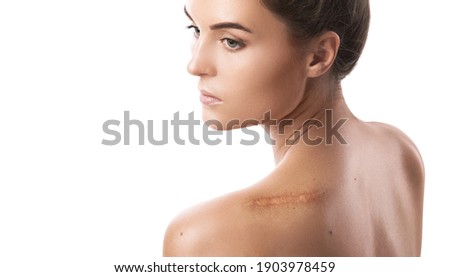 Young woman with a scar on her shoulder over white background