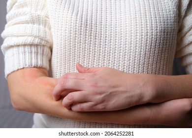 Young Woman Scratches Her Hands From Itching. Allergic Dermatitis. Skin Disease Vitiligo. Neurodermatitis Disease, Eczema Or Wool Allergy Rash. Healthcare And Medical