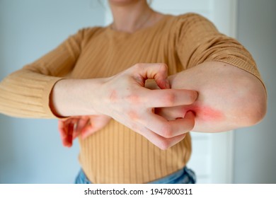 Young Woman Scratches The Itching On Her Hands With A Reddening Rash. Itching Is Caused By Dermatitis (eczema), Dry Skin, Burns, Food, Drug Allergies, Insect Bites. Health Care Concept.