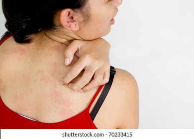 Young Woman Scratching Her Itchy Back With Allergy Rash