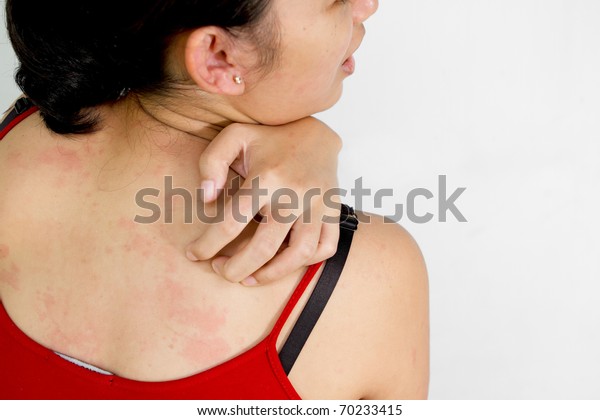 アレルギー性の発疹でかゆい背中をかく若い女性 の写真素材 今すぐ編集