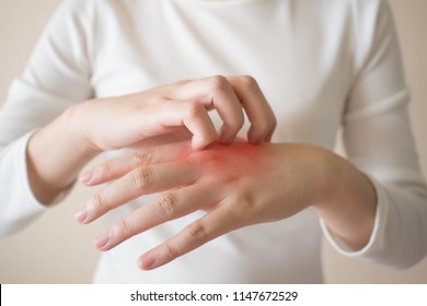Young woman scratching the itch on her hands w/ redness rash. Cause of itchy skin include dermatitis (eczema), dry skin, burned, food/drugs allergies, insect bites. Health care concept. Close up.