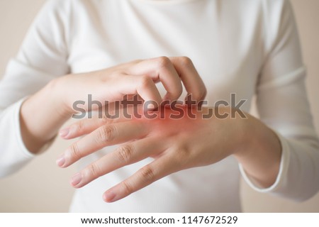 Young woman scratching the itch on her hands w/ redness rash. Cause of itchy skin include dermatitis (eczema), dry skin, burned, food/drugs allergies, insect bites. Health care concept. Close up.