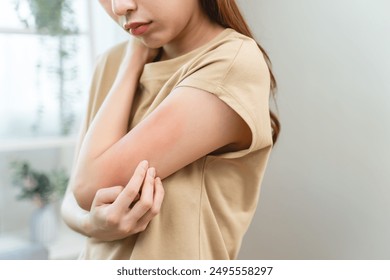 young woman scratching on her arm and has a red rash irritation on her skin from dust intolerance. - Powered by Shutterstock