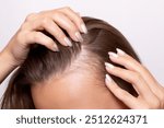 Young woman showing bald spots on forehead and temples with fingers. Baldness. Close-up. Hair care concept and treatment. Hair loss, hair transplant, alopecia