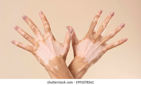 Young Woman Showing Her Vitiligo Skin Parts