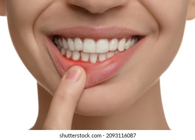 Young Woman Showing Inflamed Gums, Closeup View