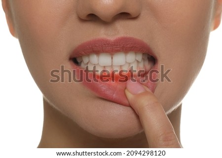 Young woman showing inflamed gums, closeup view Stockfoto © 