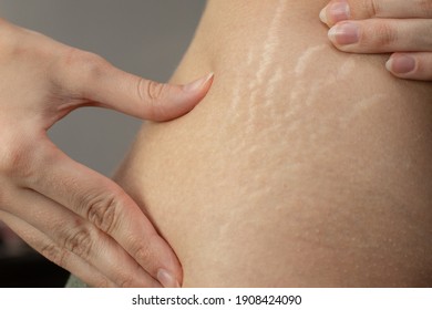 Young woman showing stretch marks on her body