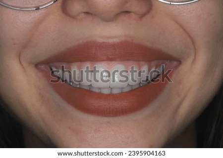 A young woman with a smile design. She has full and beautiful lips, along with aesthetic and prominent teeth.





