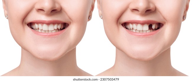 Young woman smiling before and after dental implant.