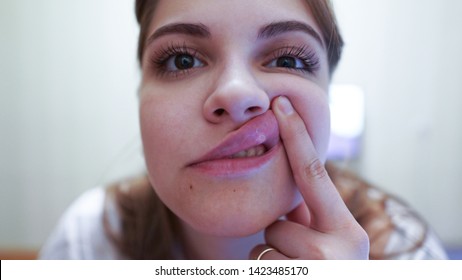 Young woman with a sore lip. Aphthous stomatitis is a common condition characterized by the repeated formation of benign and non-contagious mouth ulcers. Canker sores - Shutterstock ID 1423485170