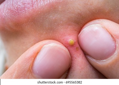 Popping Acne Images Stock Photos Vectors Shutterstock